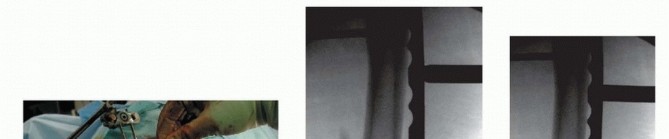 Illustration 53 for Repairing Distal Femur Fractures: Open Reduction & Internal Fixation