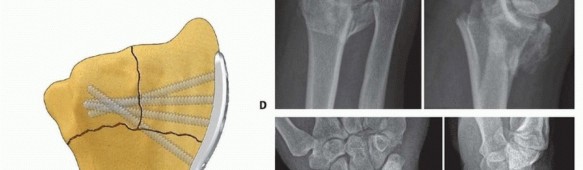Illustration 36 for Fragment-Specific Fixation: Restore Carpal Facet Horizon