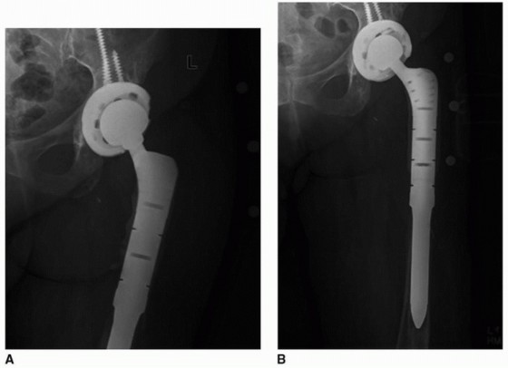 Illustration 14 for Allograft Prosthetic Composite: Mastering Proximal Femur Reconstruction