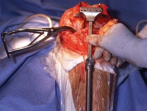 Illustration 38 for Mastering TKA: Essential Methods of Rotational Alignment