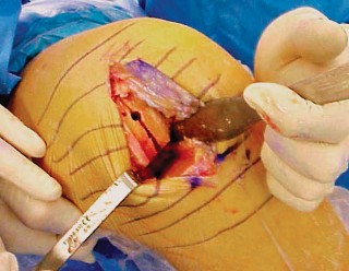 صورة طبية: جراحة استبدال مفصل الركبة الجزئي (UKA): تجنب الأخطاء والاستفادة القصوى في صنعاء مع الأستاذ الدكتور محمد هطيف