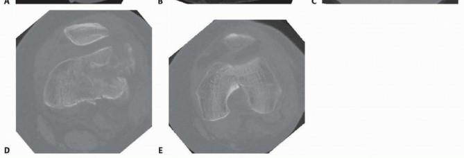 Illustration 13 for Repairing Distal Femur Fractures: Open Reduction & Internal Fixation