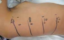 Illustration 12 for Mastering Anterior Interbody Arthrodesis with Instrumentation for Scoliosis