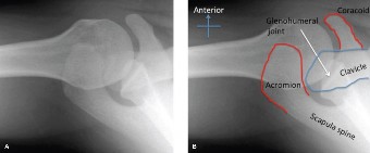 Illustration 2 for Right Shoulder Pain? Avoid This Common X-ray Mistake.