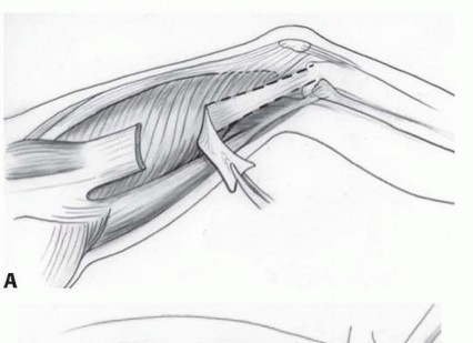 Illustration 35 for Treatment for Congenital Femoral Deficiency: What You Need to Know