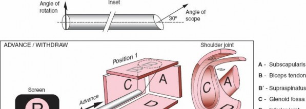 Illustration of shoulder arthroscopic approaches - Dr. Mohammed Hutaif