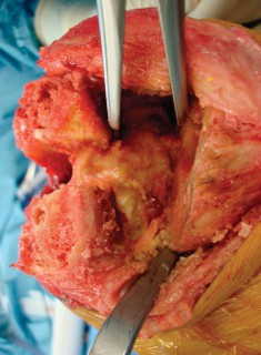 Illustration 31 for Precision Soft Tissue Balancing in Revision: Avoid TKA Pitfalls