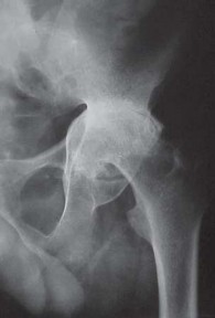 Illustration 8 for Total Hip Replacement for Protrusio: Restore Your Hip Function