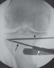 Illustration 29 for Guide Pin Assembly: Key to Flawless Upper Tibial Osteotomy