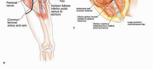 Illustration 30 for Surgical Pelvic Resection: Gluteus Maximus Muscle & Nerve Preservation