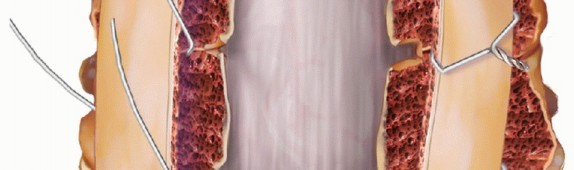 Illustration 17 for Achieve Stability: Posterior Cervical Lateral Mass Screw Fusion