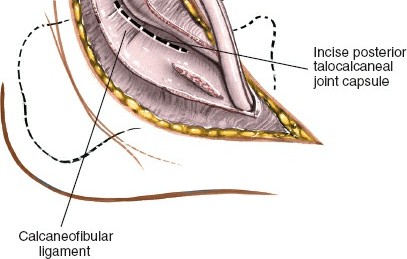 Illustration 125 for Optimized Approaches to the Dorsum of the Foot & Ankle