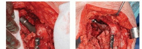 Illustration 40 for Special THA Techniques for Severe Deformities Around the Hip