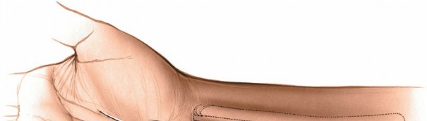 Illustration 27 for Volar Approach: Optimal Exposure for the Volar aspect of the Distal Radius