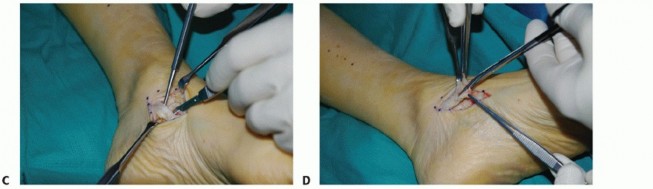 Illustration 26 for Restore Movement: Tendon Transfer for Common Peroneal Nerve Foot Drop