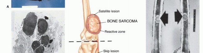 Illustration 2 for Understanding Benign Bone Tumors: Your Complete Preoperative Guide