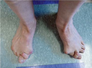 Illustration 96 for First Metatarsal Surgery: Expert Solutions for Foot & Ankle Pain