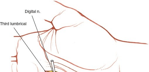 Illustration 226 for Essential Surgical Approaches: Uncover Every Aspect of the Wrist