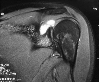 Illustration 41 for Right Shoulder Pain? Avoid This Common X-ray Mistake.