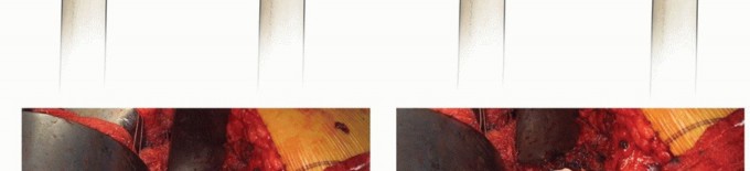 Illustration 17 for Well-Fixed THA Revisions: Precision in the Portion of the Osteotomy