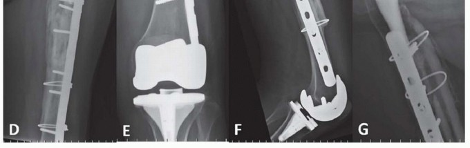 Illustration 32 for Mastering Fixation of Periprosthetic Fractures of the Femur