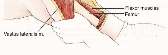 Illustration 21 for Anterior Flap Hemipelvectomy: Leveraging fig tech fig for Difficult Tumors