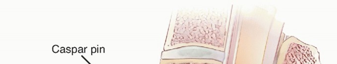 Illustration 20 for How ACDF Clears Your Posterior Disc Space for Lasting Relief