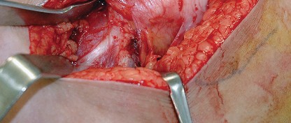 Illustration 19 for Unlock the Figure Posterior Approach to the Hip