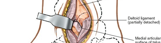 Illustration 23 for Optimized Approaches to the Dorsum of the Foot & Ankle