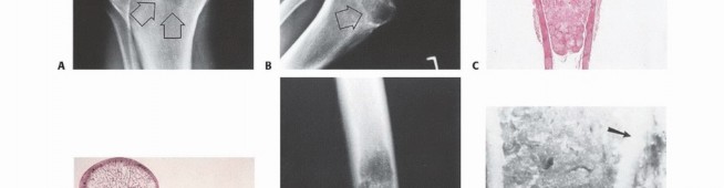 Illustration 48 for Understanding Benign Bone Tumors: Your Complete Preoperative Guide