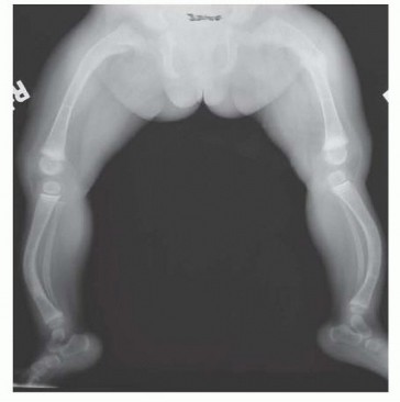 Illustration 2 for Less Pain, More Function: Fassier-Duval Nailing for Osteogenesis Imperfecta