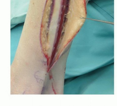 Illustration 32 for Free Vascularized Fibular Grafts: Solving Complex Bone Defects