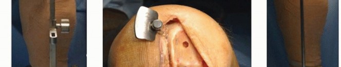 صورة طبية: استبدال مفصل الركبة الجزئي: حل متقدم لآلام الركبة المستمرة مع الأستاذ الدكتور محمد هطيف