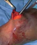 Illustration 29 for Optimal Nailing of the Tibia: Techniques for Challenging Fractures