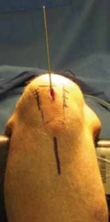 Illustration 33 for Optimal Nailing of the Tibia: Techniques for Challenging Fractures