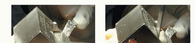 Illustration 27 for Achieve Lasting Pain Relief with Cemented Total Knee Arthroplasty