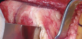 Illustration 47 for Mastering Valgus Total Knee Replacement: Techniques & Pitfalls