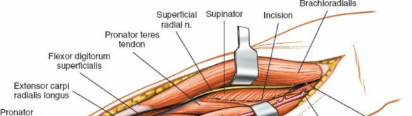 Illustration 10 for Radius Anterior Approach: Safe Nerve Protection & Complete Exposure