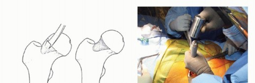 Illustration 19 for Anterior FAI Relief: Mini-Open Anterior Approach Explained