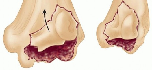 Illustration 2 for Navigating Capitellum and Capitellar-Trochlear Shear Fracture Repair