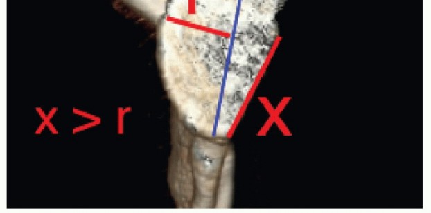 Illustration 8 for Glenoid Bone Graft for Anterior Shoulder Instability: Restore Stability