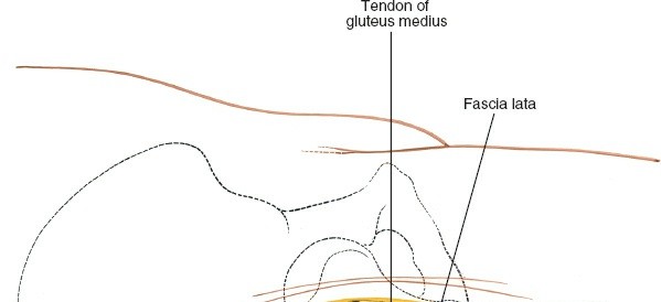 Illustration 131 for Unlocking Every Aspect of the Hip's Surgical Approaches