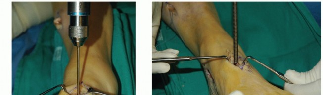 Illustration 32 for Restore Movement: Tendon Transfer for Common Peroneal Nerve Foot Drop