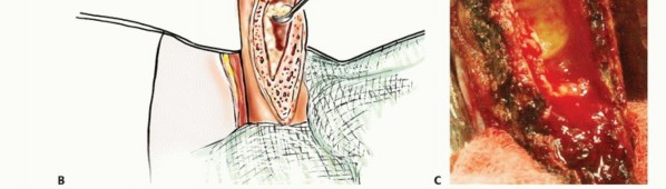 Illustration 16 for Restore Vital Function: Surgery for Type II Humeral Metastasis