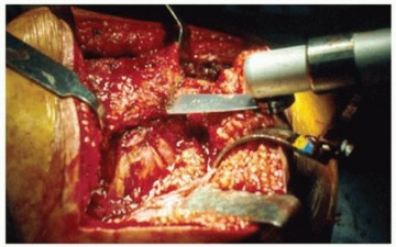 Illustration 33 for Sliding Trochanteric Osteotomy: Modern Role & Refined Techniques