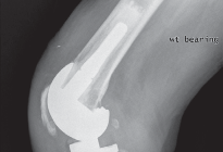 Illustration 23 for Porous Metal Cones: Biologic Fixation for Severe Bone Loss