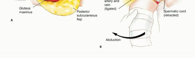 Illustration 18 for Posterior Flap Hemipelvectomy: Mastering Techniques for Optimal Outcomes