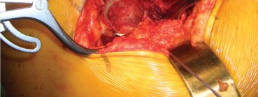 Illustration 94 for Successful Total Hip Replacement in Developmental Dysplasia