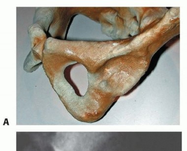 Illustration 3 for Mastering Anterior Open Reduction for Developmentally Dislocated Hip