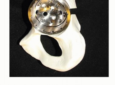 Illustration 6 for Pelvic Discontinuity: Understanding Superior and Inferior Separation